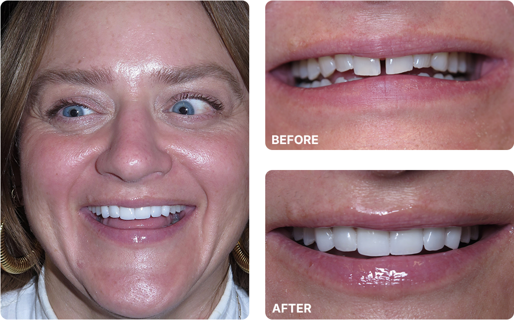 Veneers Before and After Images