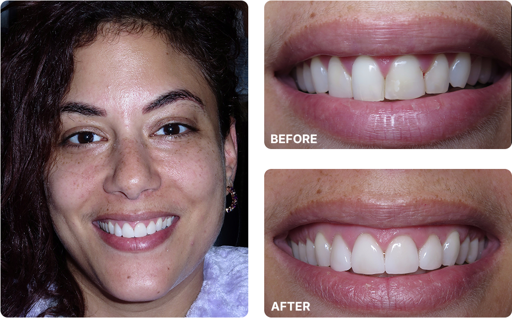 Veneers Before and After Images