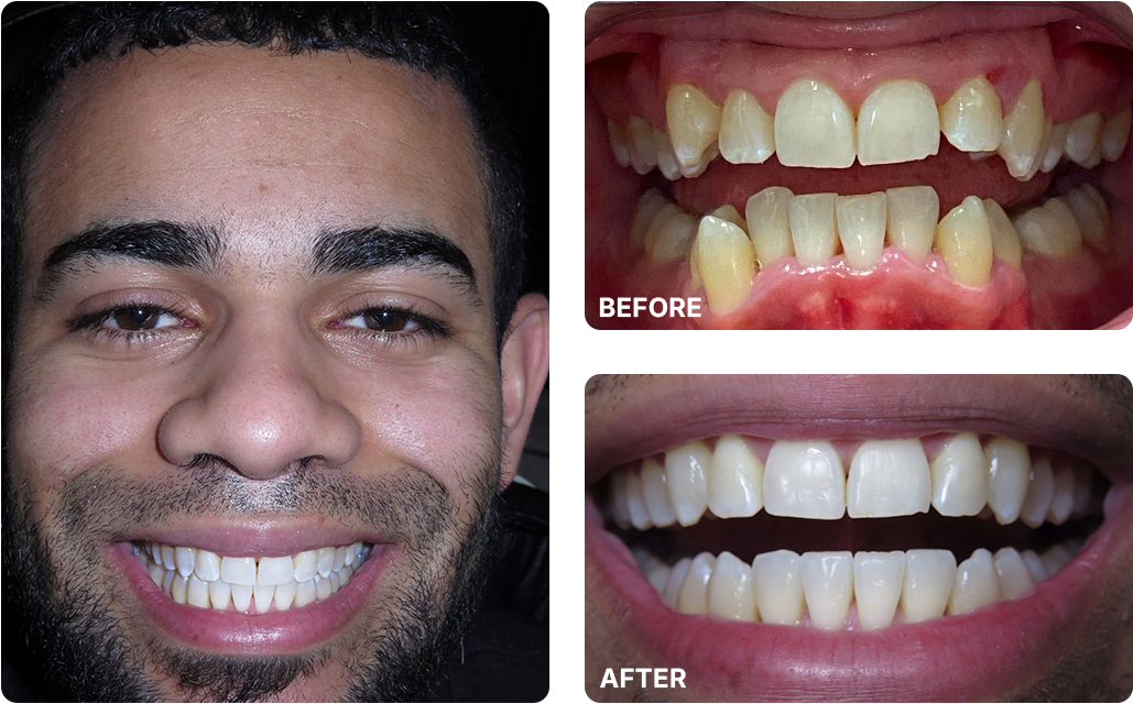 Invisalign Before and After Images
