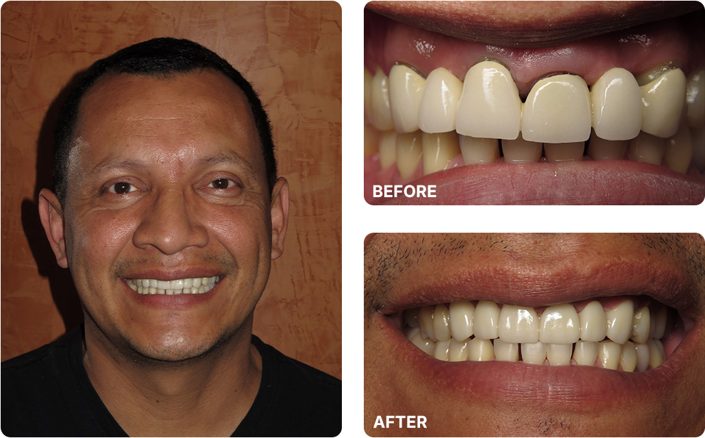 Bridge Before and After Images