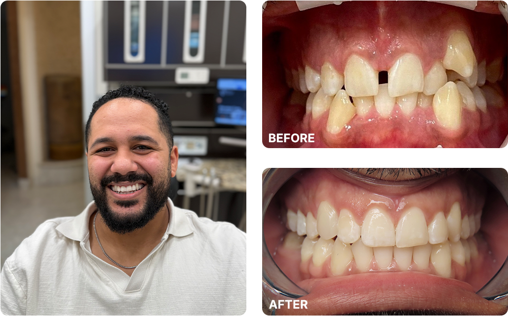 Invisalign Before and After Images