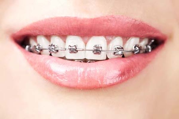 Adult Braces