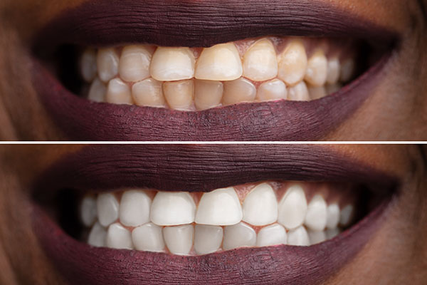Benefits Of Professional Teeth Whitening Sessions