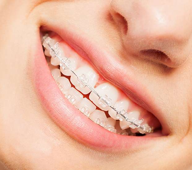 Coral Gables Clear Braces