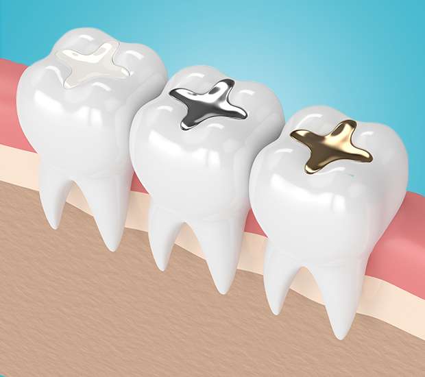 Coral Gables Composite Fillings