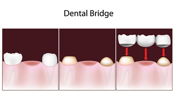 Dental Bridges