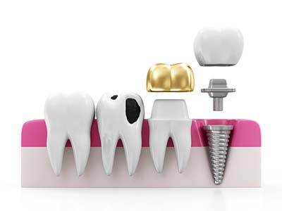 Fillings in Dentistry, What is it? Learn all about it.