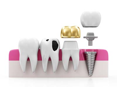 Dental Crowns