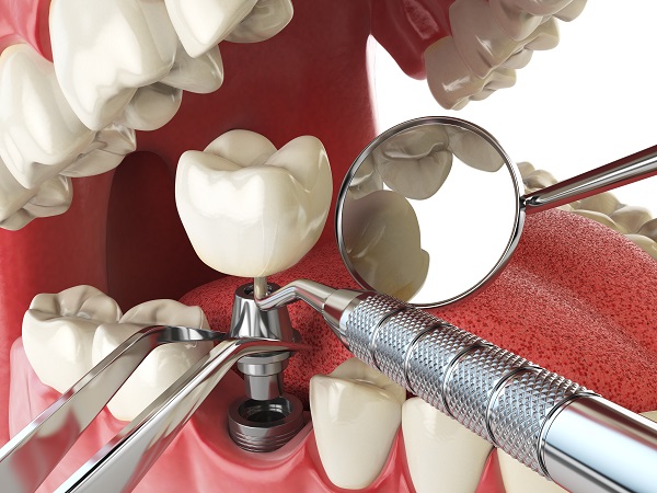 Dental Implants: Replace Your Missing Teeth