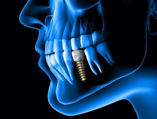 dental implants Coral Gables, FL