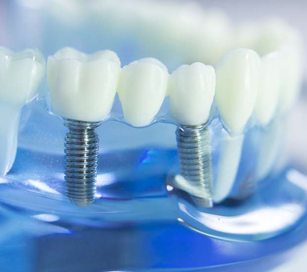 Coral Gables Dental Implants