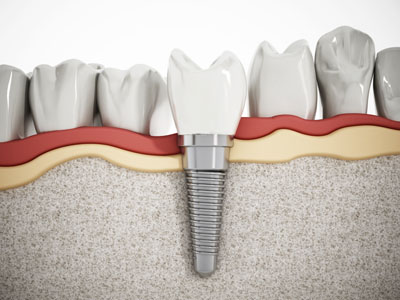 Implant Dentist