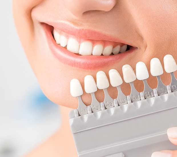 Coral Gables Dental Veneers and Dental Laminates