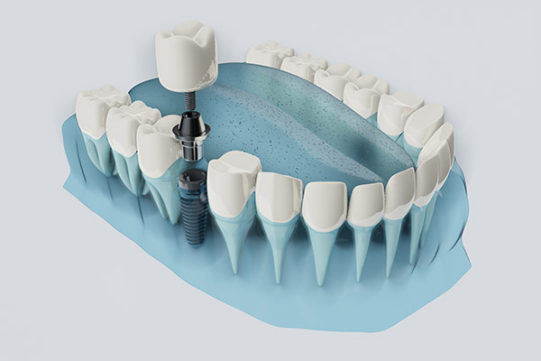 FAQs about Dental Implants from Gables Exceptional Dentistry in Coral Gables, FL