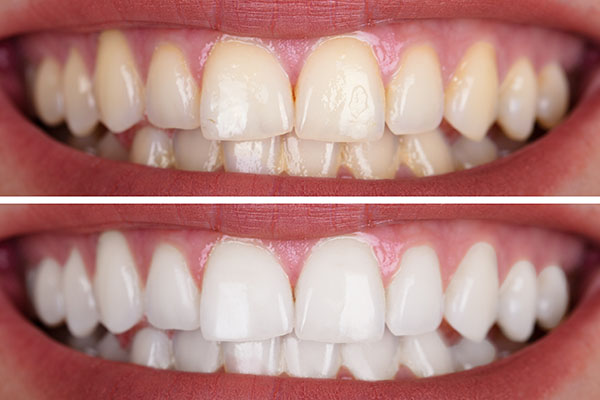 How Long do the Results of Teeth Whitening Treatments Last? from Gables Exceptional Dentistry in Coral Gables, FL