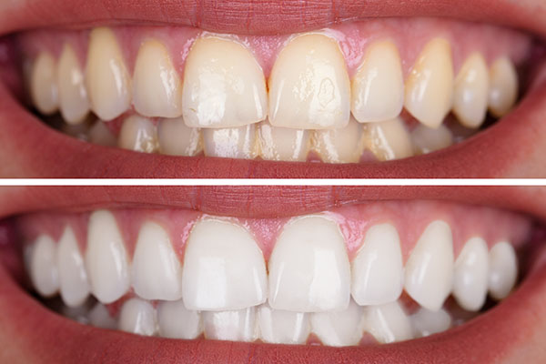 Does a Dental Veneer Treatment Damage Teeth? - Gables Exceptional