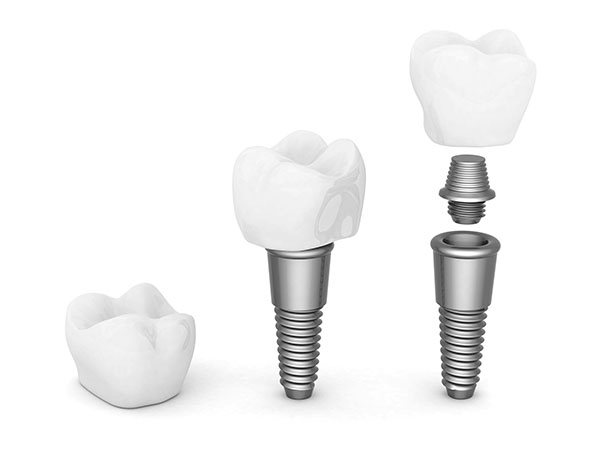 An Implant Restoration Treatment In Coral Gables Can Improve Your Smile And The Function Of Your Teeth
