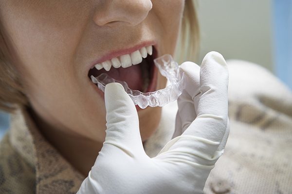 Invisalign Dentist