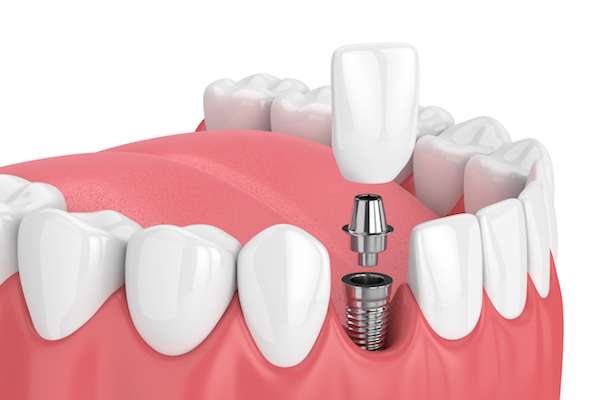 Mini vs. Regular Dental Implants from Gables Exceptional Dentistry in Coral Gables, FL