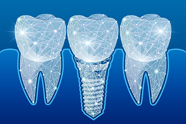 Preventing Complications After Getting Dental Implants from Gables Exceptional Dentistry in Coral Gables, FL