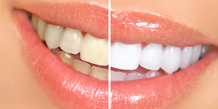 Get White Dental Fillings in Coral Gables & Miami - South Gables Dental