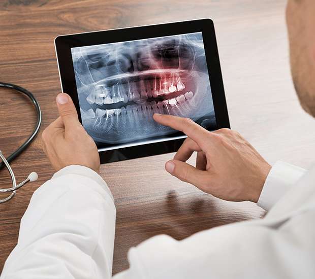 Coral Gables Types of Dental Root Fractures