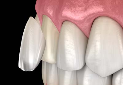 Invisalign Coral Gables, FL