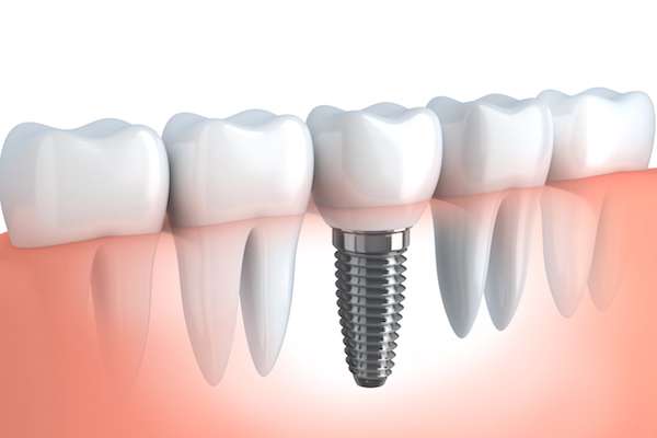 Your Ultimate Guide to Getting Dental Implants from Gables Exceptional Dentistry in Coral Gables, FL